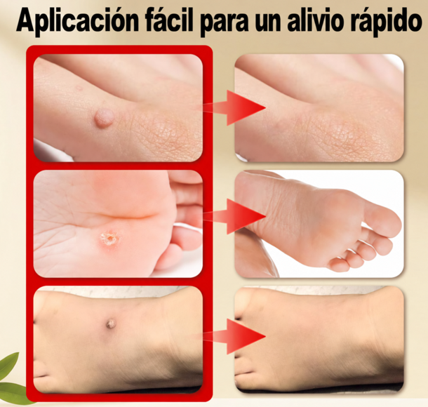 Crema para Remover Verrugas