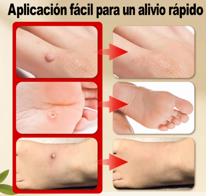 Crema para Remover Verrugas